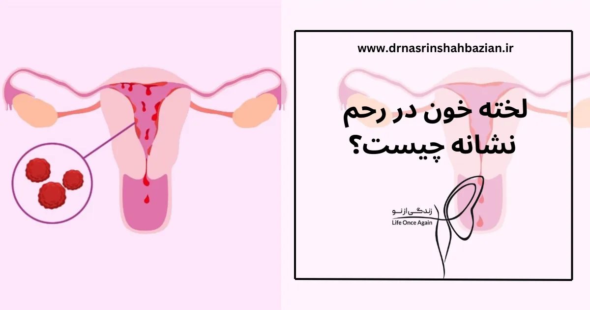 لخته خون در رحم